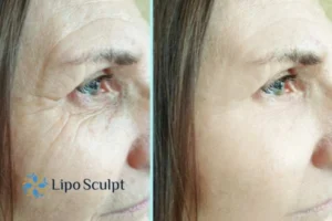 How to Fight Aging Symptoms 2 Do you want to Fight Aging Symptoms Ravensthorpe? Contact Lipo Sculpt today!