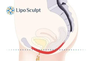 Pelvic Floor Chair Therapy 1 Pelvic Floor Chair Therapy Ravensthorpe to treat incontinence.