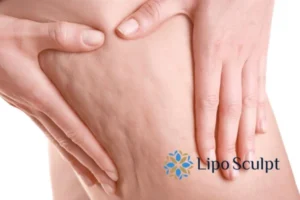 CoolSculpting for Legs: The Innovative Approach to Redefining Your Legs 5 Start your journey today book your coolsculpting treatment Ravensthorpe online today!