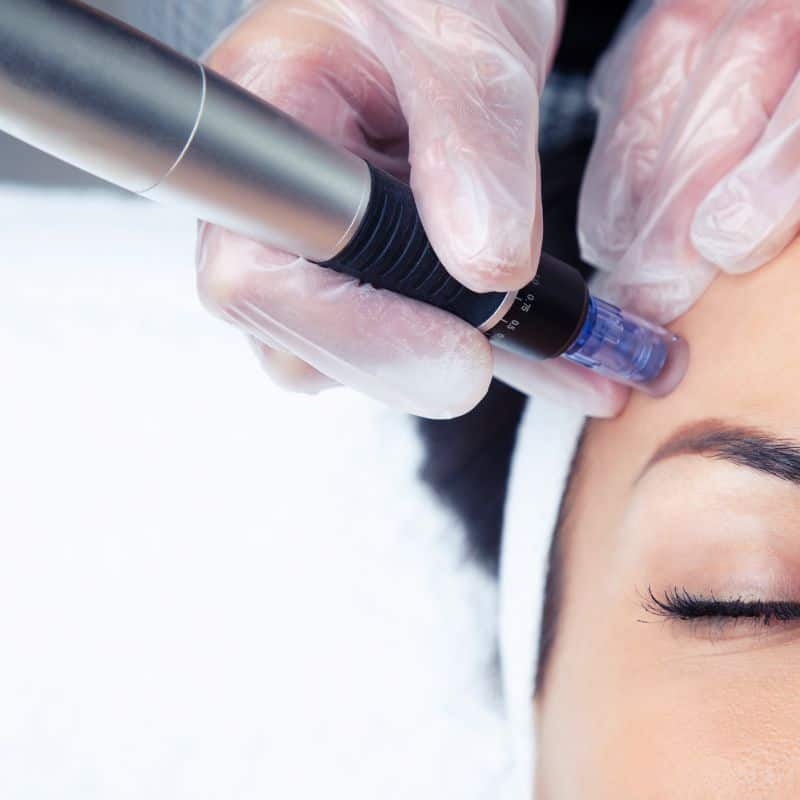 Morpheus8 treatment Ravensthorpe from Lipo Sculpt - Book in today!